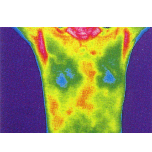   乳腺診斷

熱成像可以用來檢測(cè)乳房組織的溫度差異，由于腫瘤組織的新陳代謝通常高于正常組織，它們可能會(huì)在熱圖像上表現(xiàn)為熱斑。